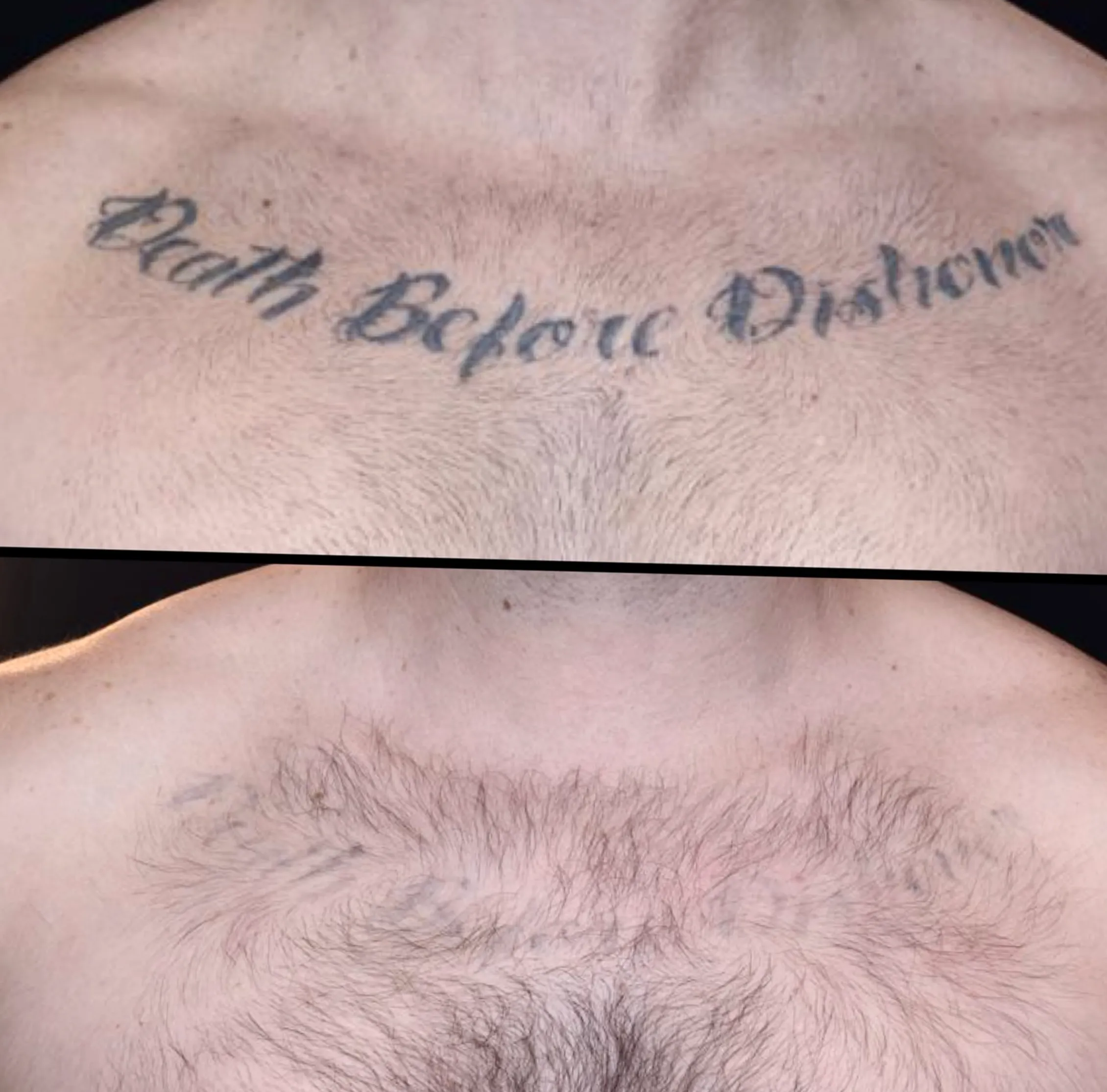 picosecond laser tattoo removal