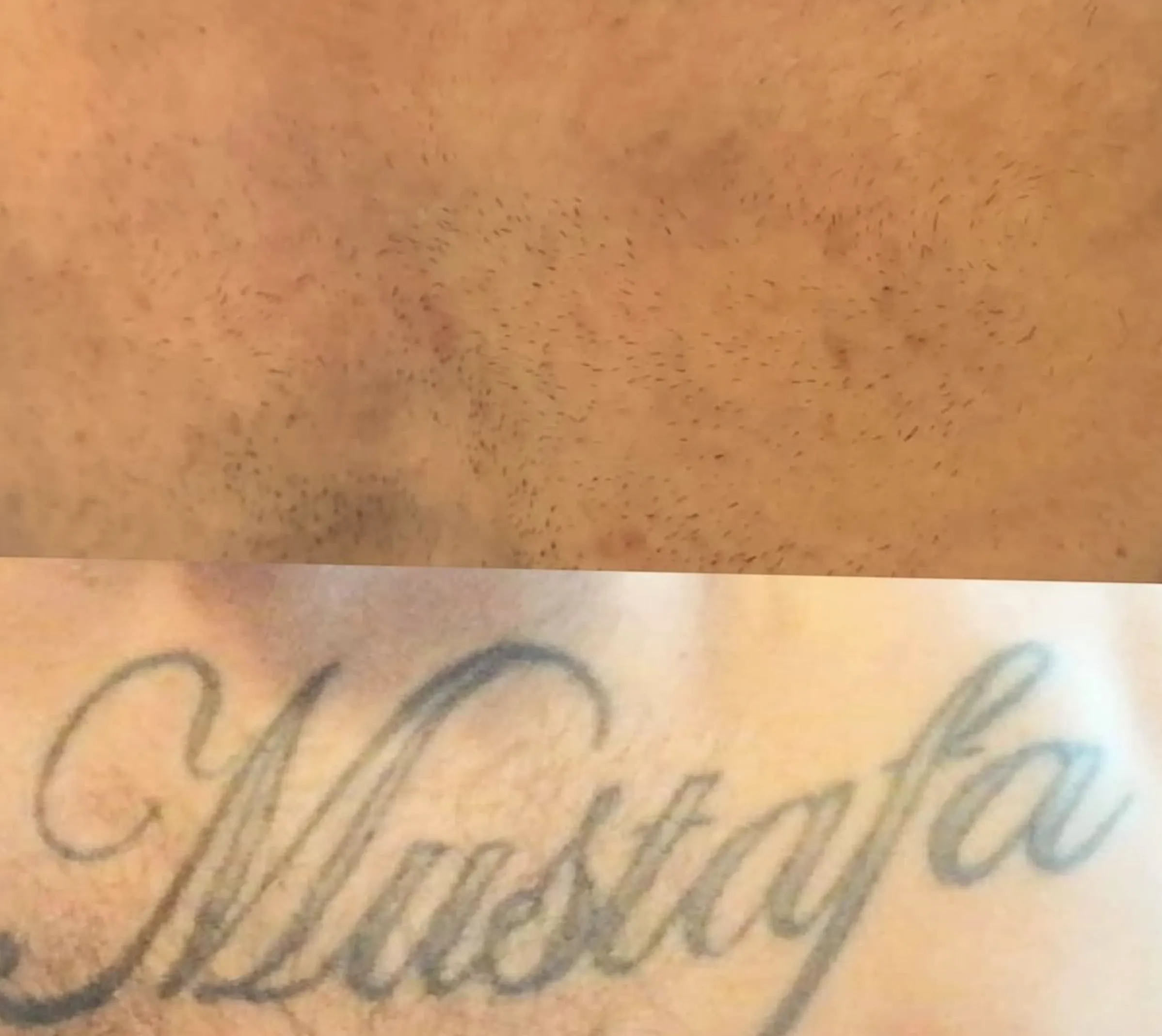 eyeliner tattoo removal