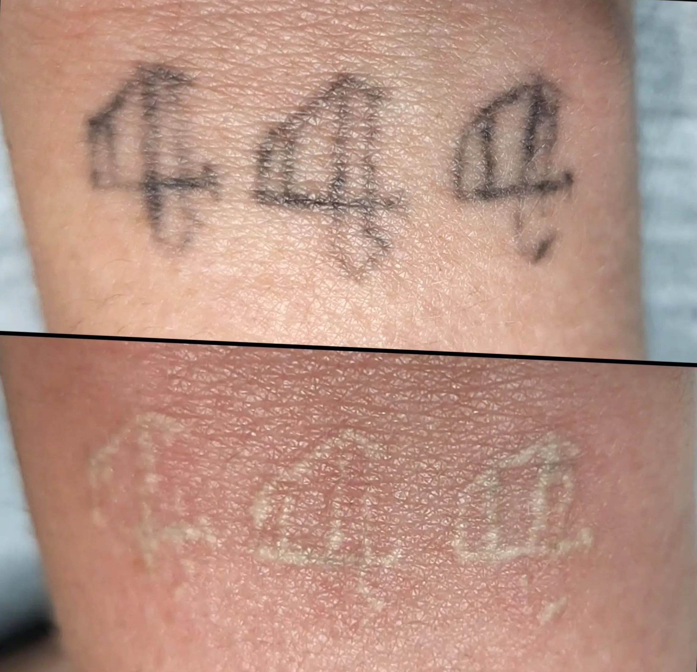 eyebrow tattoo removal Melbourne