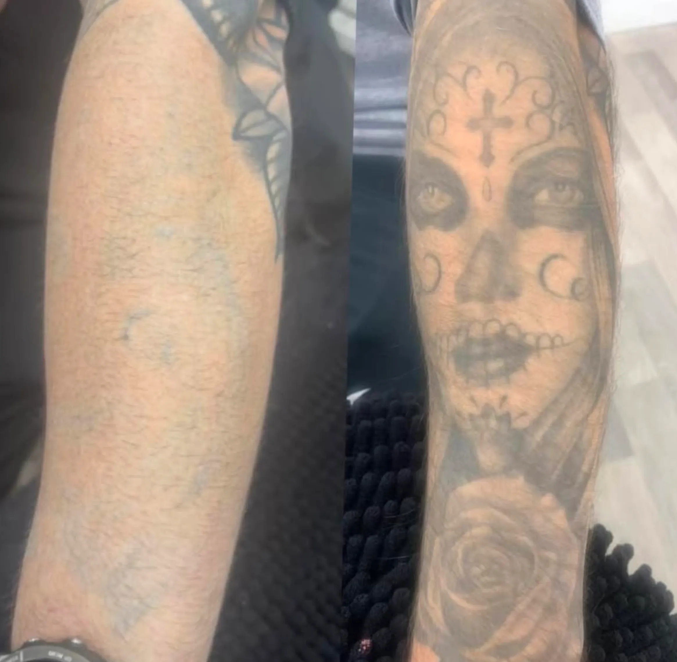 best laser for black tattoo removal