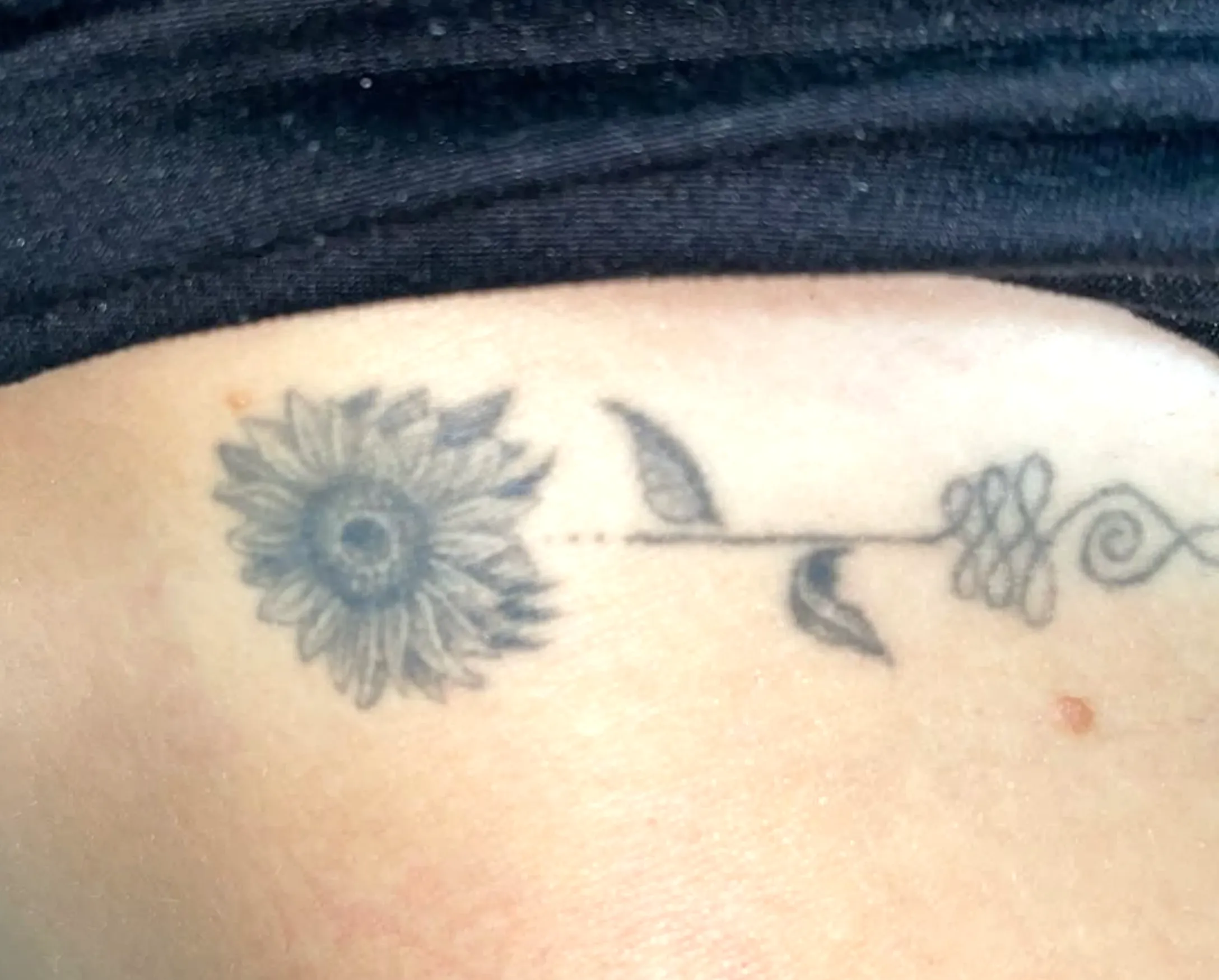 black tattoo removal Melbourne