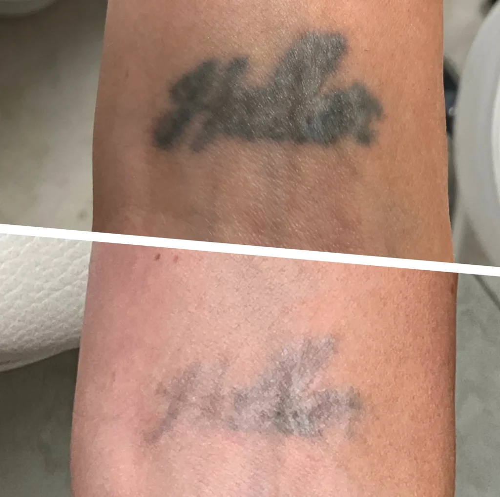Can a black ink tattoo be removed?