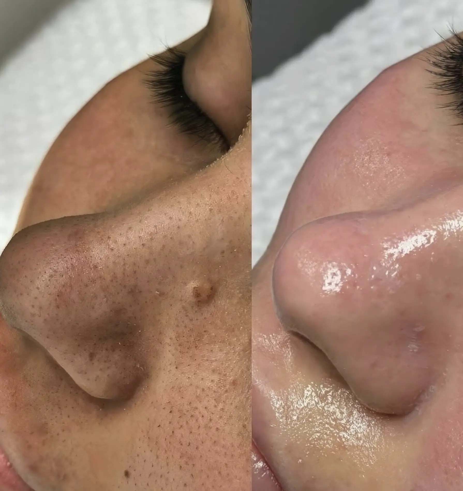 best hydrafacial brisbane